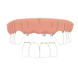 Pont fixe de 4 dents assis sur 3 implants